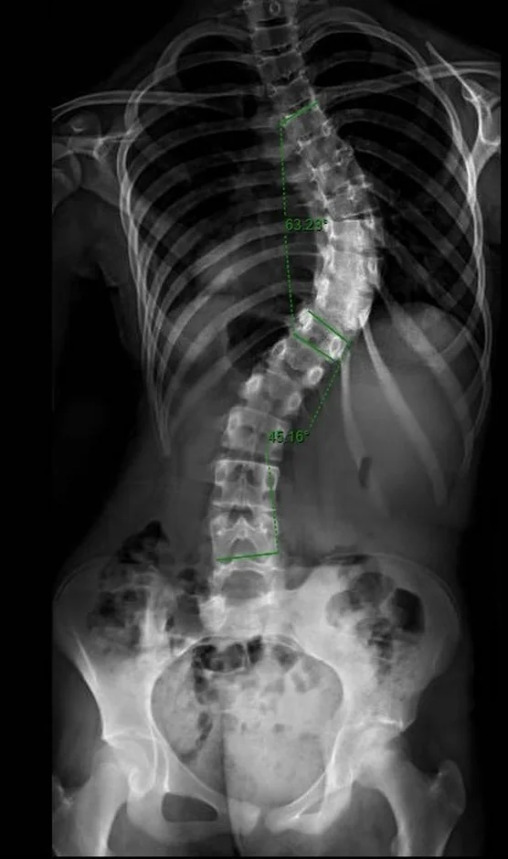 Radiografia antes da cirurgia, mostrando a curva