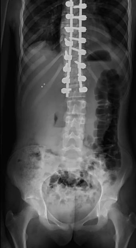 Radiografia após a cirurgia, com a coluna instrumentada