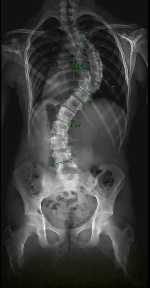 Radiografia antes da cirurgia, mostrando a curva