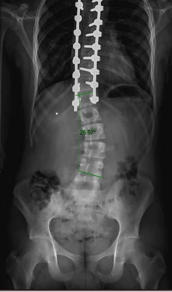 Radiografia após a cirurgia, com a coluna instrumentada