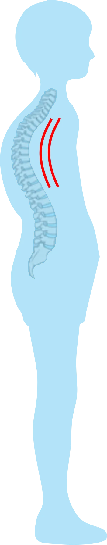 Silhueta com hipercifose, acentuação da curvatura dorsal