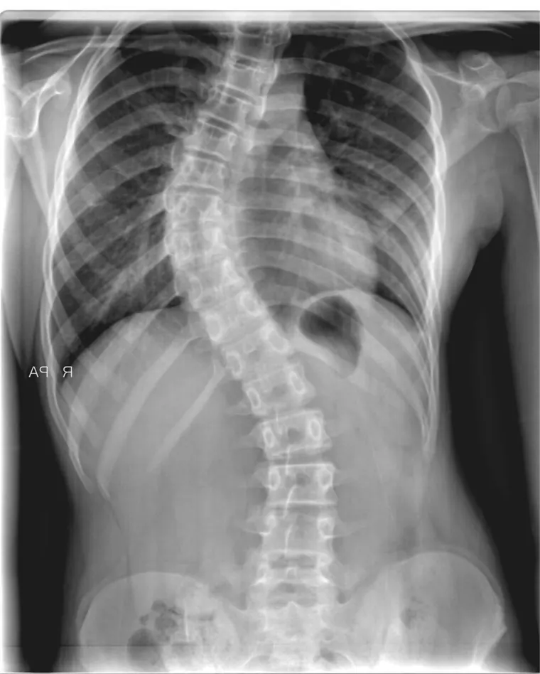 Radiografia de coluna em pé mostrando uma curva escoliótica